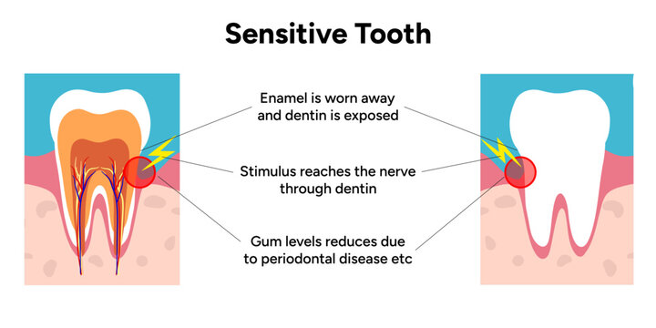 Hand-drawn illustration of tooth sensitivity anatomy in educational style. Tooth structure, exposed dentin, enamel wear, and nerve pathways that cause sensitivity 