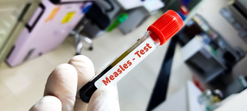 Blood sample for Measles or Rubella test. To diagnose paroxysmal nocturnal hemoglobinuria (PNH),