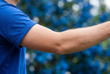 Fototapeta premium Close up of human arm skin with distinct goosebumps reaction to cold or emotion