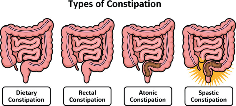 Medical infographic vector illustrating types of constipation including dietary rectal atonic and spastic conditions for gastroenterology education digestive health awareness 