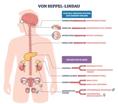 Von Hippel Lindau syndrome map shows tumor sites in brain, retina, kidneys, and pancreas, noting hemangioblastomas and renal cell carcinoma. Key, brain, kidneys, pancreas. Outline diagram