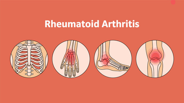 Medical of rheumatoid arthritis in hand, wrist, knee, and foot joints