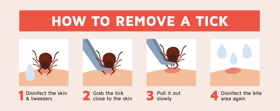 Removing tick. Step by step instructions for removing stuck insect, detection parasite, peddler of serious diseases, medical infographic poster, garish vector cartoon isolated concept