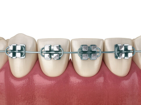 Isolated self-ligating metal braces on a row of human teeth with healthy pink gums.