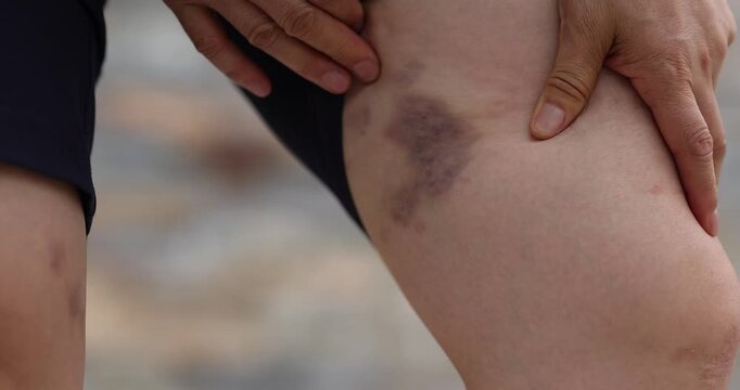 People show the bruised legs  