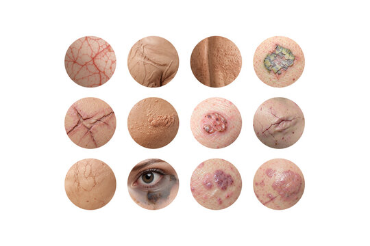 Common skin problems and dermatological conditions set, ai generated. Close up various skin irritation with acne, wrinkles, scars and dermatology disorder. Medical and skincare concept, isolated.
