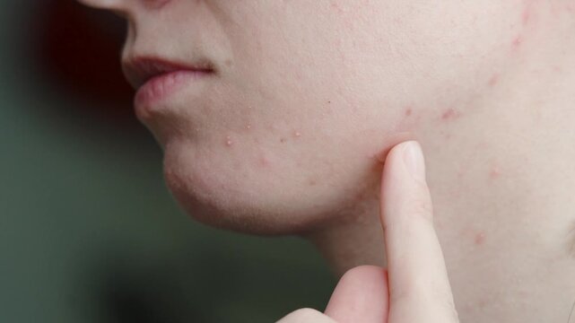 A young woman putting a transparent anti acne pimple patch or tape. Skin routine procedure