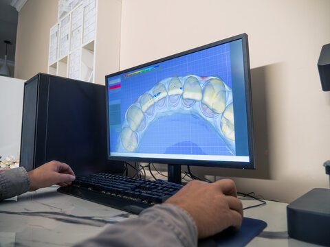 Dental CAD design on computer screen, technician planning tooth restoration in laboratory, digital dentistry workflow, prosthodontics, healthcare technology.