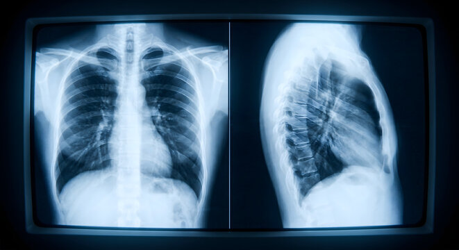 胸郭と脊椎の構造を示す胸部レントゲン画像の正面と側面イメージ
