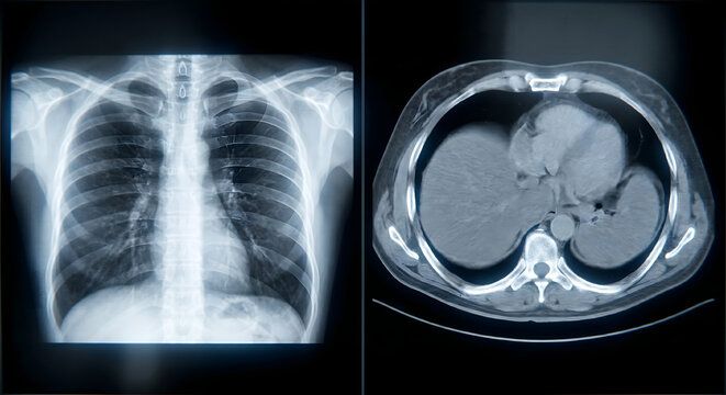胸部レントゲンと心臓・肺の水平断（上面）CTスキャン画像の医療イメージ
