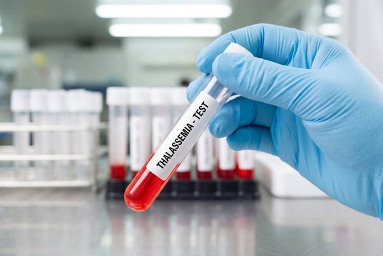 Lab technician holding thalassemia blood test tube sample