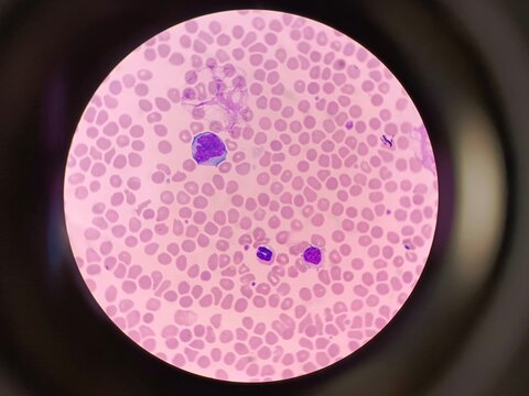Atypical mononuclear cells or virocytes in a blood smear under light microscope for diagnosis 