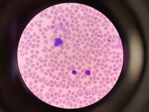 Atypical mononuclear cells or virocytes in a blood smear under light microscope for diagnosis 