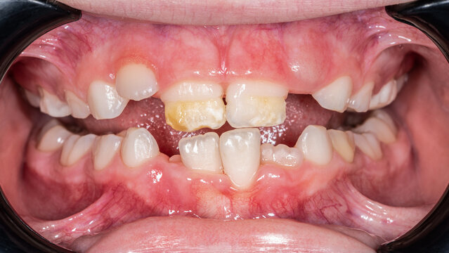 Local hypoplasia of the central permanent incisors in a child.	