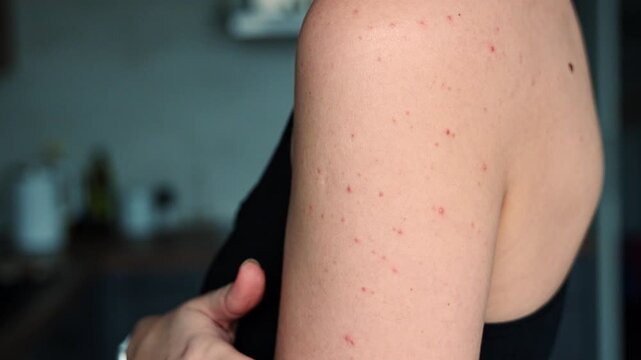 Hormonal acne on shoulder skin in adult woman. Skin problems and body changes due to hormonal imbalance concept.