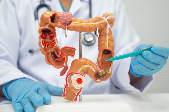 Colorectal cancer, doctor holding intestine colon human anatomy model.
