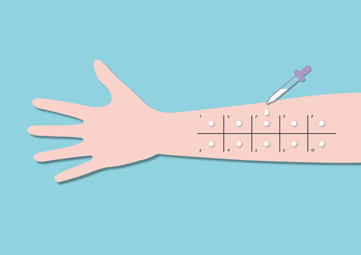 Allergy testing, illustration