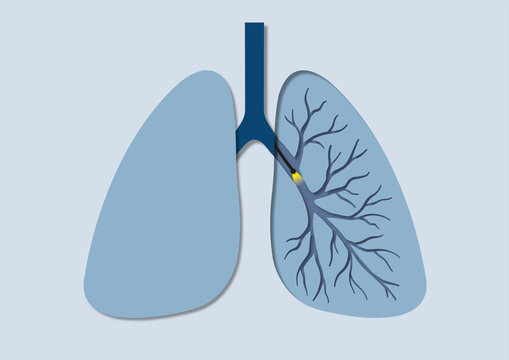 Bronchoscopy, conceptual illustration