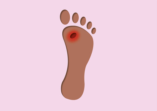 Foot ulcer, conceptual illustration