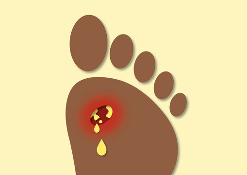 Foot ulcer, conceptual illustration