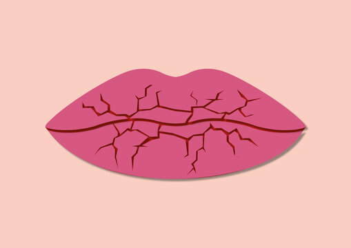 Cracked lips, conceptual illustration