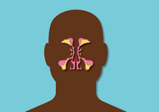 Unhealthy sinuses, conceptual illustration
