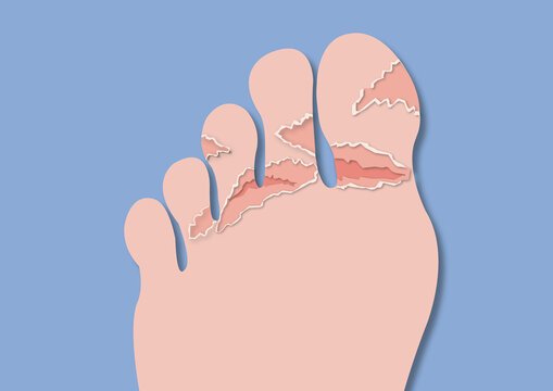 Athlete's foot infection, illustration