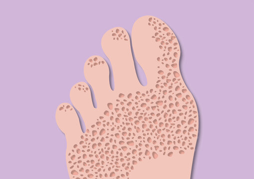 Pitted keratolysis, conceptual illustration