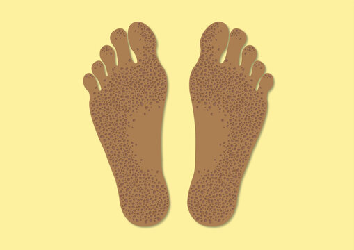 Pitted keratolysis, conceptual illustration