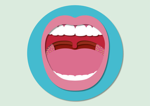 Tonsillitis, conceptual illustration