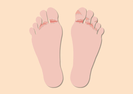 Athlete's foot infection, illustration
