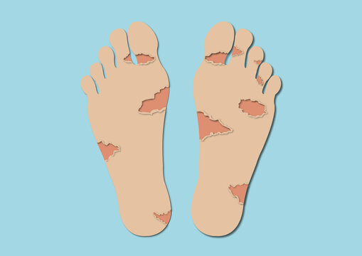 Peeling skin, conceptual illustration