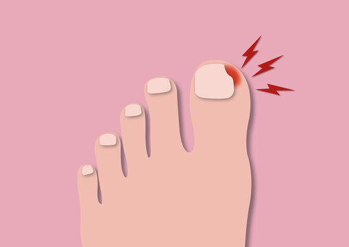 Ingrown toenail, conceptual illustration
