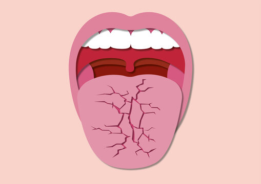 Dry mouth, conceptual illustration