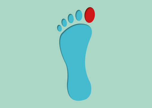 Ingrown toenail, conceptual illustration