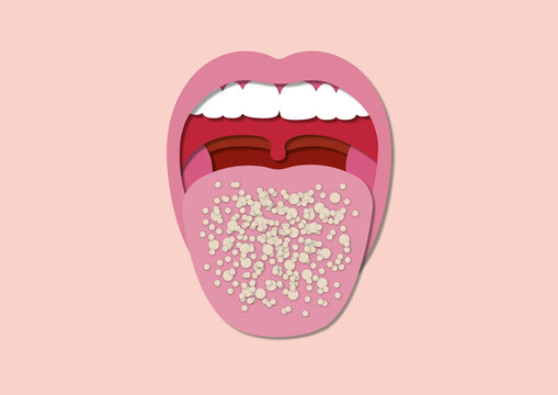 Oral thrush, conceptual illustration