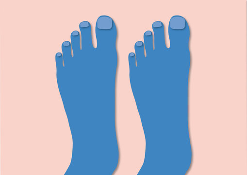 Two left feet, conceptual illustration