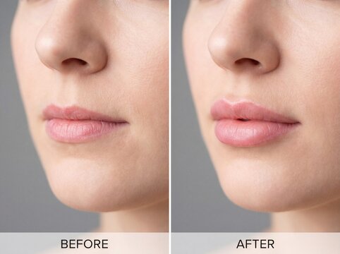 A woman's lips before and after lip filler treatment