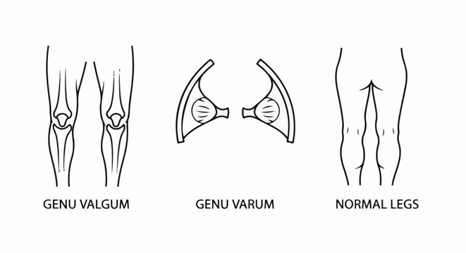 Line drawings illustrate normal, knock-kneed, and bow-legged stances
