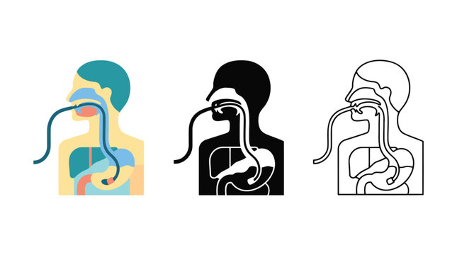 Nasogastric tube feeding medical illustration showing tube placement in digestive system.