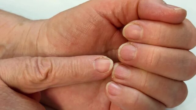 Long unpainted uncut nails of an elderly woman's hands in close-up. Unkempt hands and feet.
