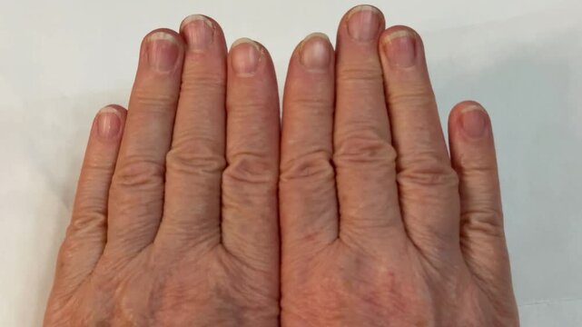 Grandma's wrinkled old hands. Untrimmed fingernails. Calluses and roughness and microcracks on the skin of the hands. Close-up.