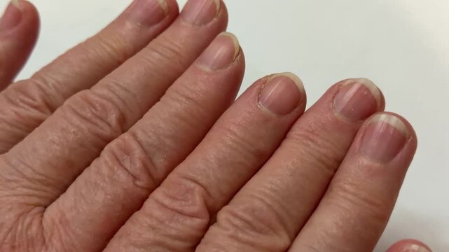 Grandma's wrinkled old hands. Untrimmed fingernails. Calluses and roughness and microcracks on the skin of the hands. Close-up.