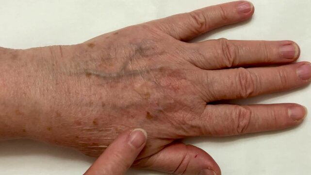 A woman's hand with pigmented and wrinkled nails on a white background. Close-up.