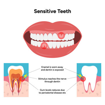 Hand-drawn illustration of tooth sensitivity with visual examples teeth. Educational enamel wear, exposed dentin, and reaction to hot and cold stimuli. causes of tooth sensitivity and oral discomfort