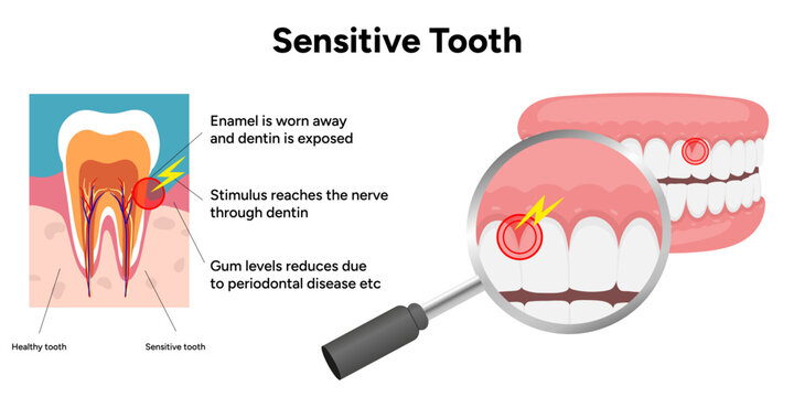 Hand-drawn illustration of tooth sensitivity with visual examples teeth. Educational enamel wear, exposed dentin, and reaction to hot and cold stimuli. causes of tooth sensitivity and oral discomfort