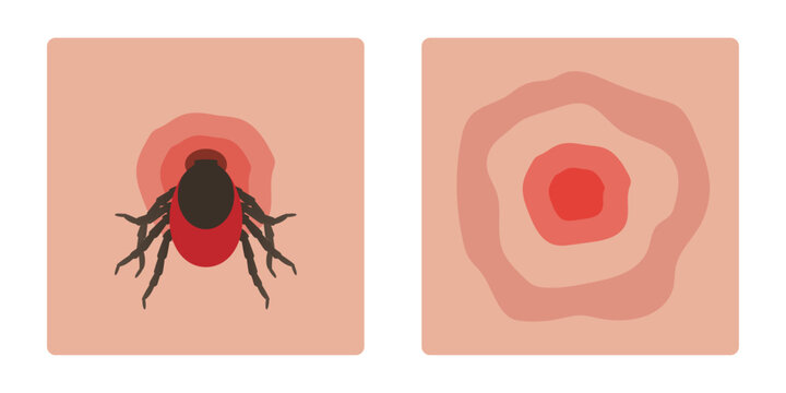 Tick Bite with Erythema and Bite Mark. Signs of Lyme Disease. Vector hand drawn illustration