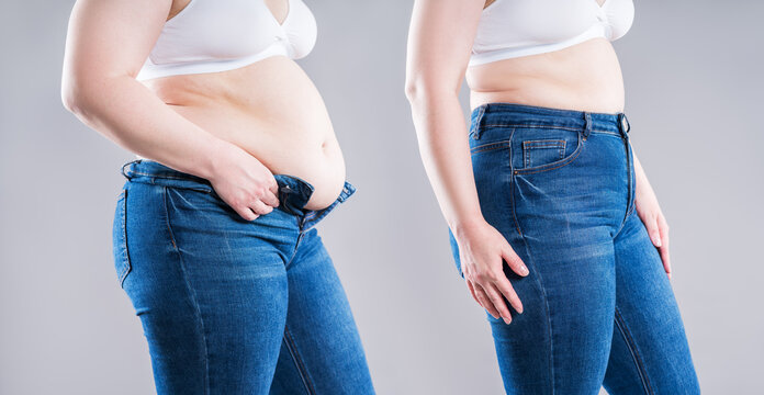 Before and after weight loss transformation, woman's fat body showing slimming results, liposuction, plastic surgery and tummy tuck
