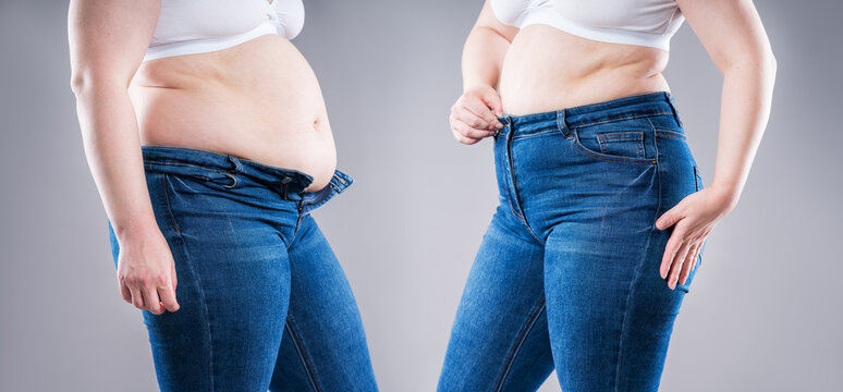 Before and after weight loss transformation, woman&rsquo;s fat body showing slimming results, liposuction, plastic surgery and tummy tuck