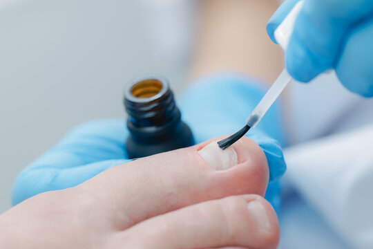 Close-up of manicure on toenail with blue gloves and brush applicator, podiatrist treatment restoration procedure